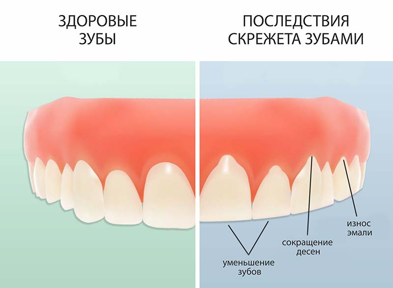 Фото Как Делают Зубы